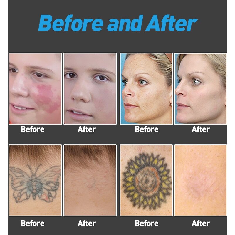 Picosecond Laser Machine Manufacturer - Q Switched Nd Yag 1064nm 755nm 532nm