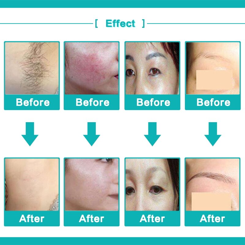 Hair Removal Equipment Manufacturer - Portable Professional OPT Skin Rejuvenation