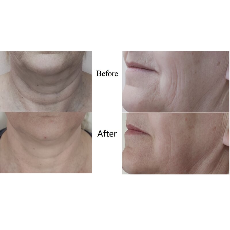 Microcurrent Instrument Manufacturer - AU-8403 Portable 3 in 1 Galvanic BIO Face Lift