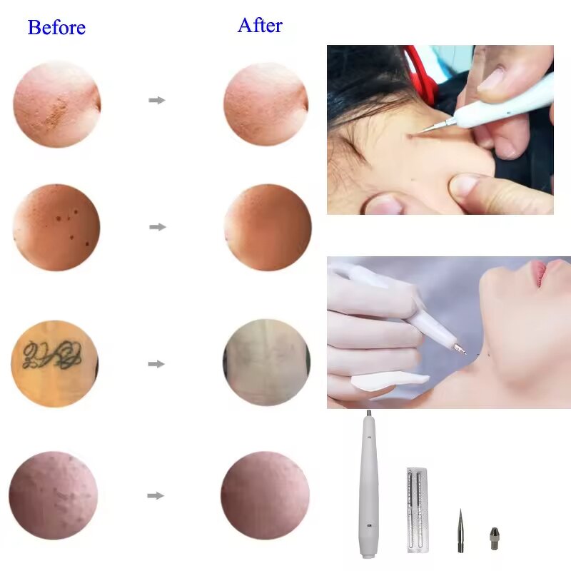 Electro Cautery Machine Manufacturer - AURO Portable Pen for Warts & Mole Removal