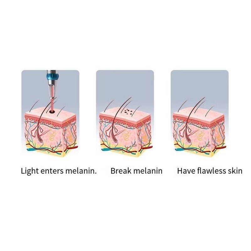 Picosecond Laser Machine Manufacturer - Professional Ultra-Small ND YAG