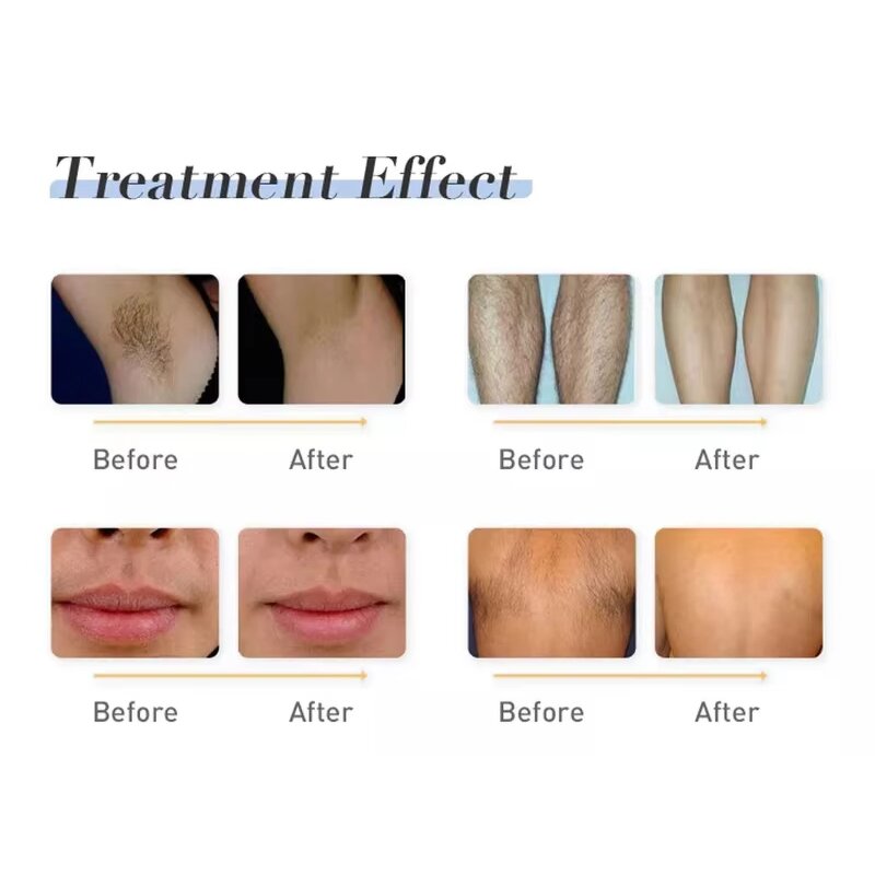 Diode Laser Hair Removal Machine Manufacturer - 755nm 808nm 1064nm Permanent