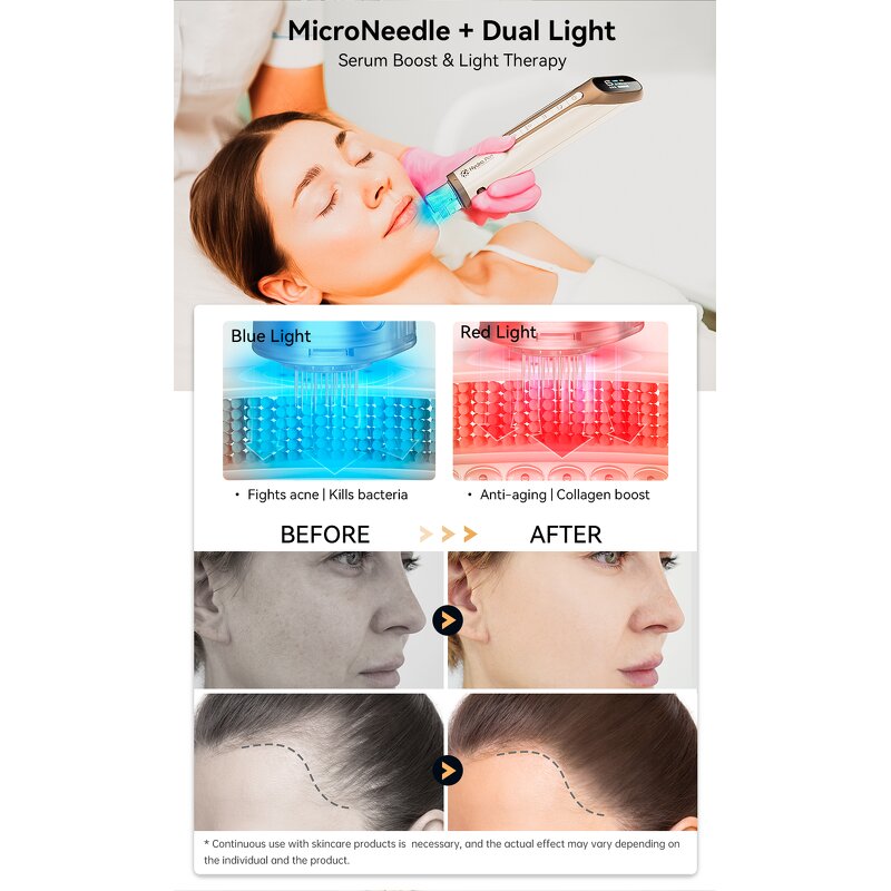 Microneedling Pen Manufacturer - Ekai H6 Gold Screw Type MTS Nano