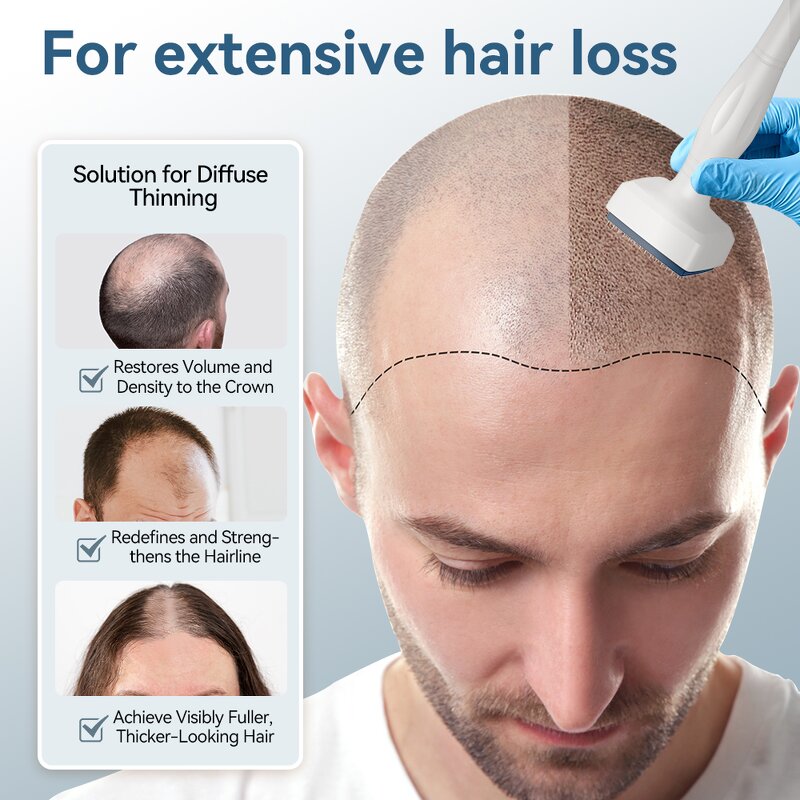 Derma Roller Manufacturer - 140 Stainless Steel Microneedles