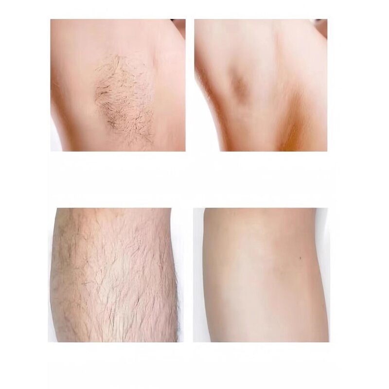 808nm Diode Laser Device - Painless At Home Laser Hair Removal Beauty Equipment