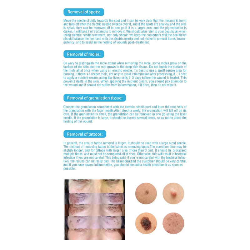 2 in 1 Plasma Pen - Best Fibroblast Ozone Therapy Eyelid Lifting Mole Removal Tool