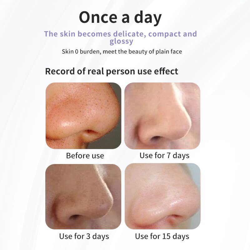 Small Bubble Blackhead Remover - 2024 New Arrival Water Cycle Electric Vacuum Cleaner