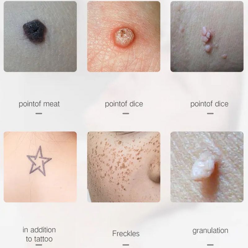 Plasma Pen - Spot Mole Removal Fibroblast LCD Skin Tag Freckle Wart Remover