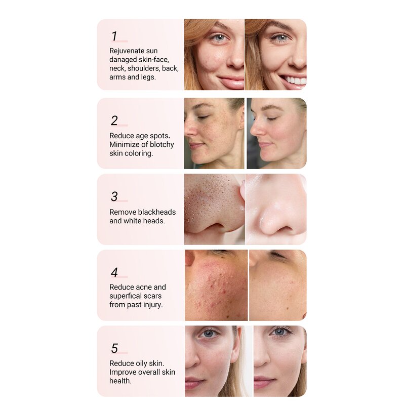 Multifunctional Aqua Peeling Machine - Beauty SPA RF Skin Tightening Facial Deep Cleaning