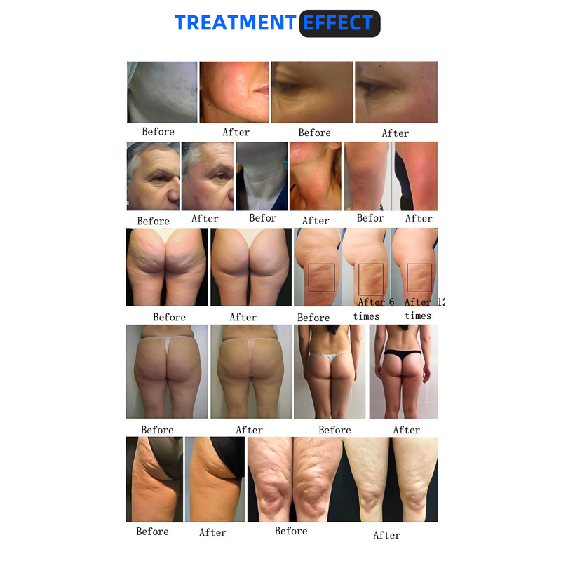 ADG 360 Inner Ball Roller - Professional Lymphatic Drainage Body Sculpting Machine