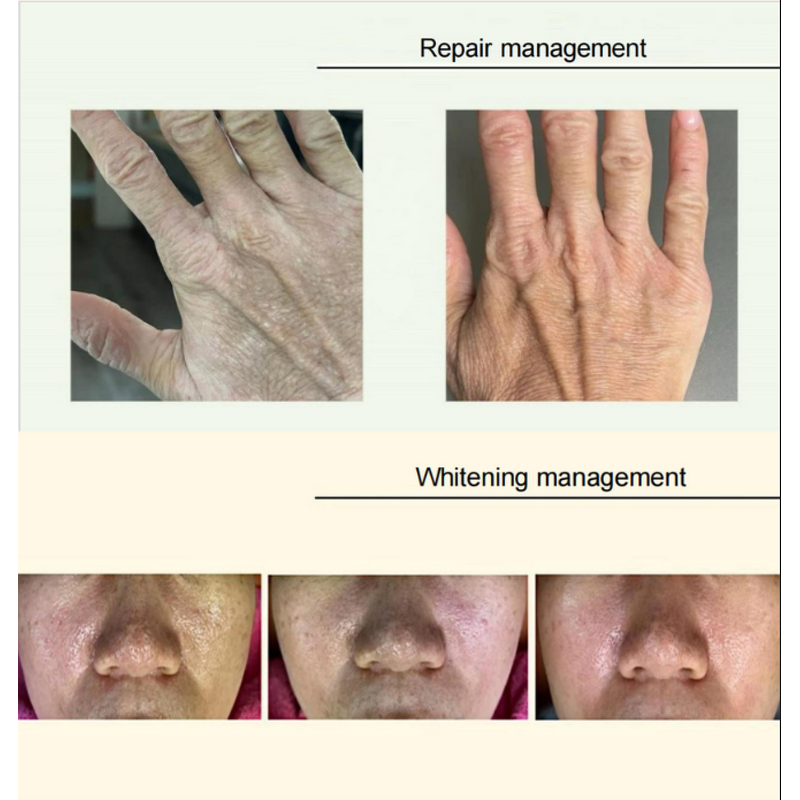 8 in 1 Fraction Plasma - Spot Removal Skin Tightening Face Lift US/IT/ZA Plug