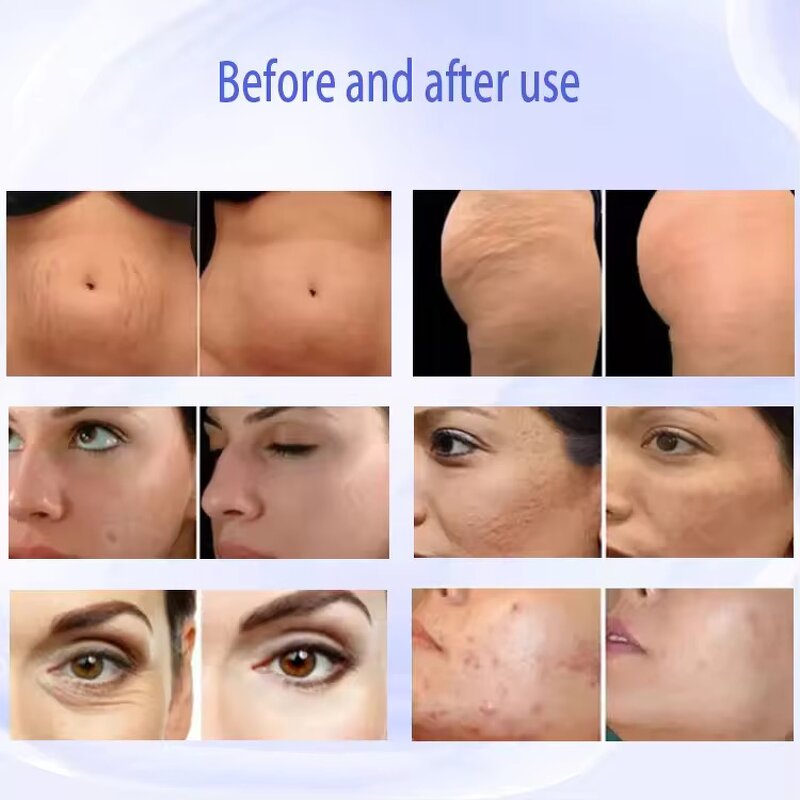 Morpheus8 Fractional Machine - New Arrival High RF Facial Skin Rejuvenation Salon