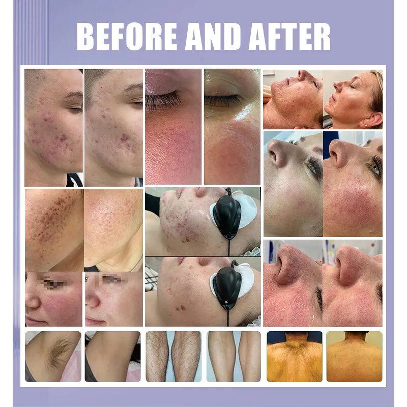 M22 2-in-1 Beauty Machine - 3000W IPL OPT Nd Yag Hair Tattoo Removal