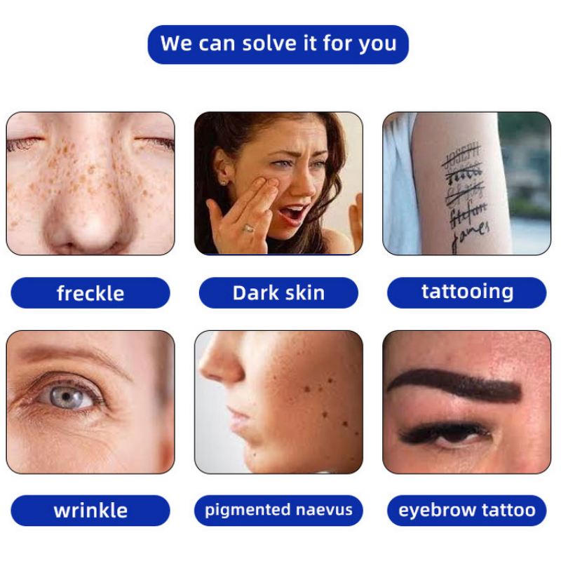 High Power Picosecond Laser - New Design Tattoo Removal Carbon Peeling Machine