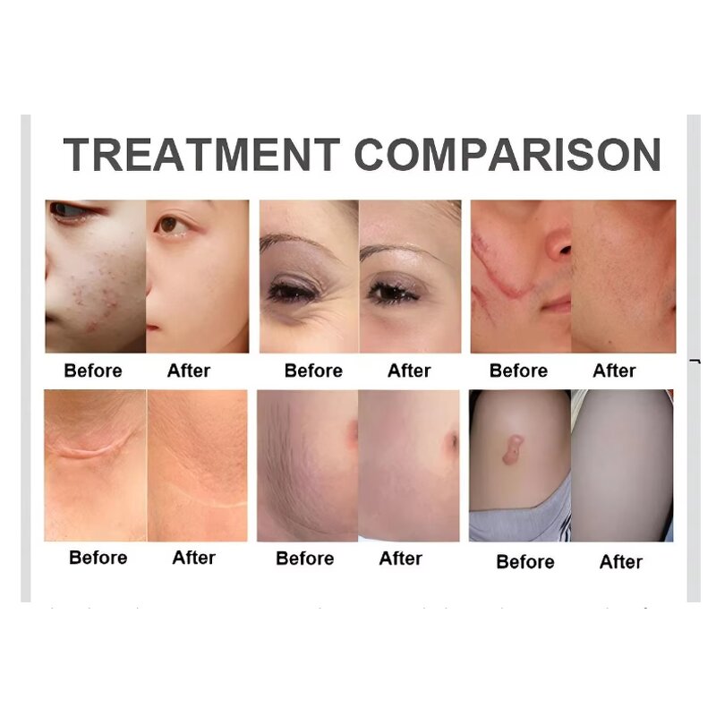 Fractional CO2 Laser Machine - 2025 Portable 10600nm Skin Resurfacing Anti-Aging