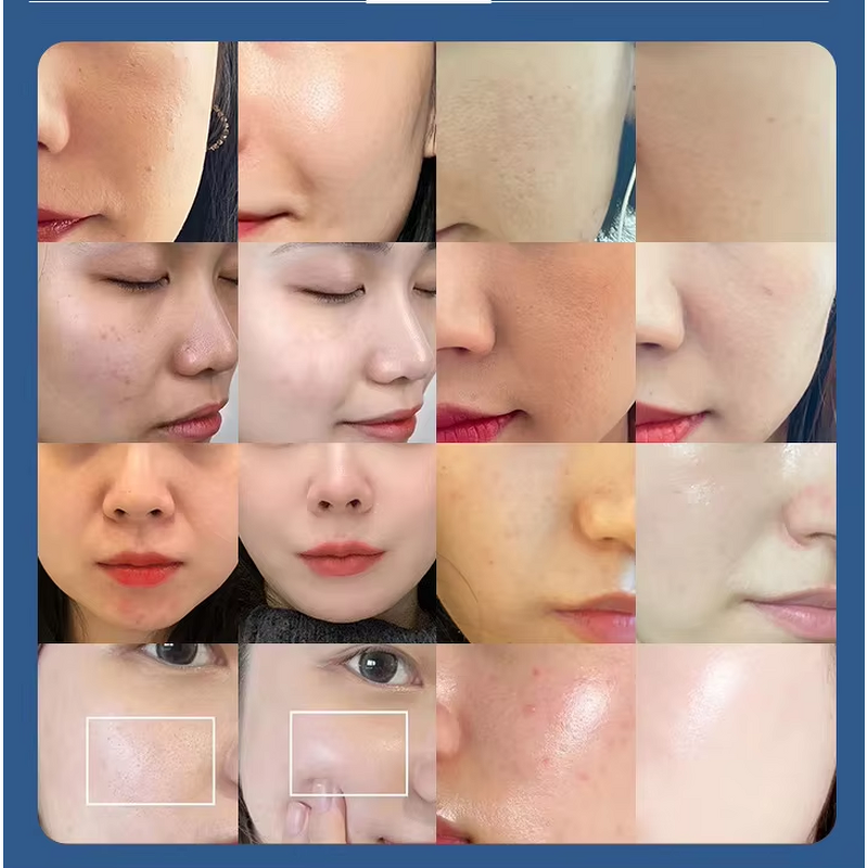 RF Microneedle Crystallite 8 - Gold Beauty Instrument Rejuvenation Wrinkle Removal