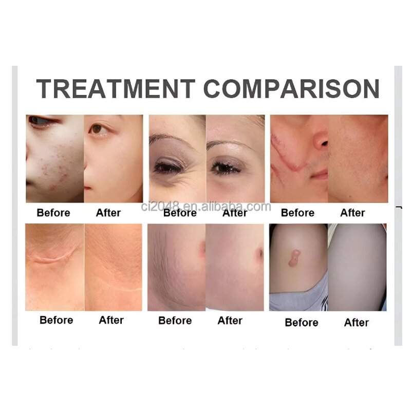 ADG Fractional CO2 Laser - Portable Skin Tightening Face Lifting Stretch Marks Removal