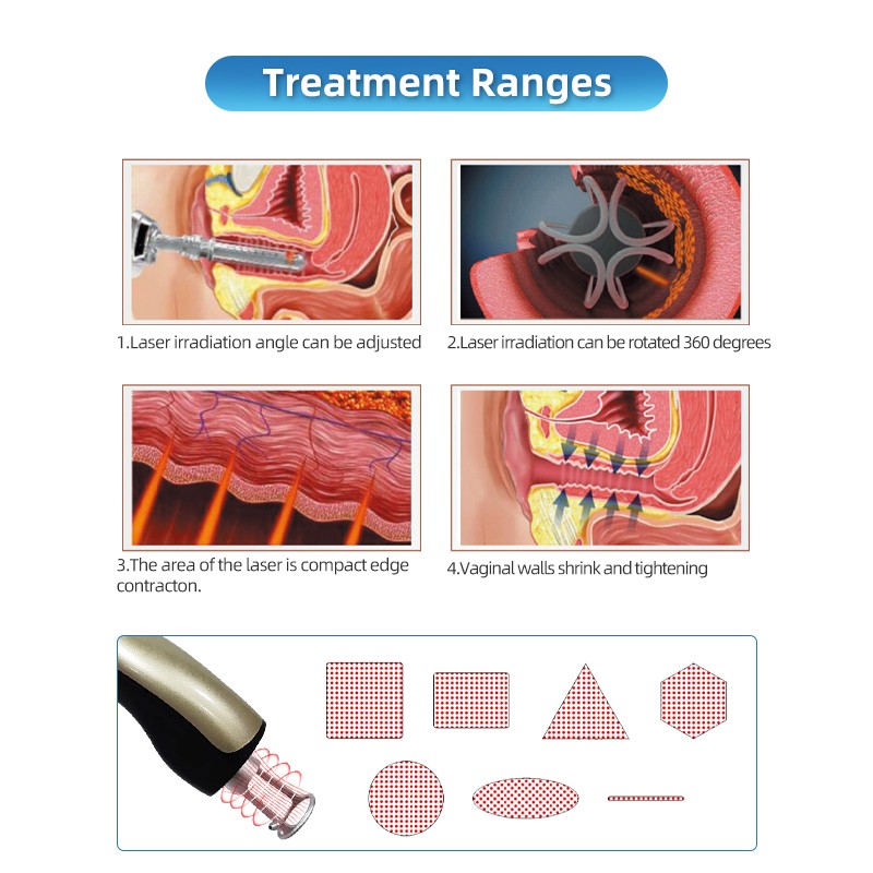 Skin Rejuvenation Laser Factory - Bowket Vaginal Tightening CO2 60W Fractional Laser Machine