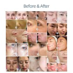 hydrogen facial machine