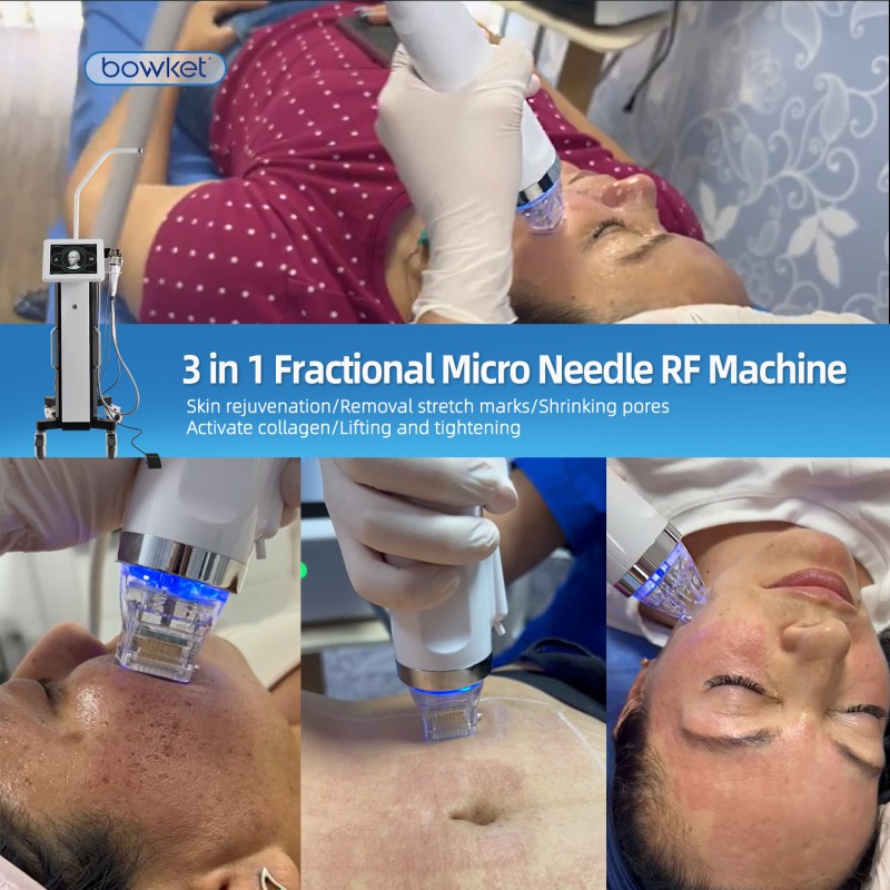 Acne Remover Device Factory - Bowket 3 In1 Fractional Microneedling with Rf