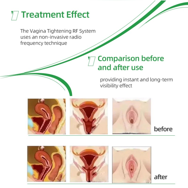 Portable RF Device Manufacturer - Face Lift Vaginal Tightening Beauty Targeted for Virginian Area US ZA UK