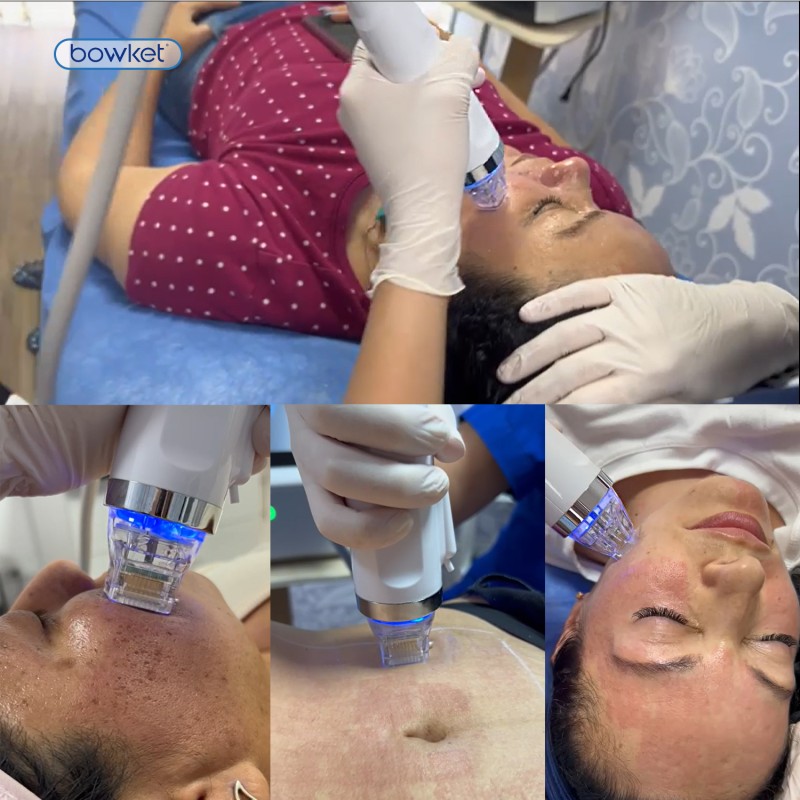 Micro Needle RF Factory - BOWKET Electric Facial Beauty Fractional Microneedling for Eye Wrinkle