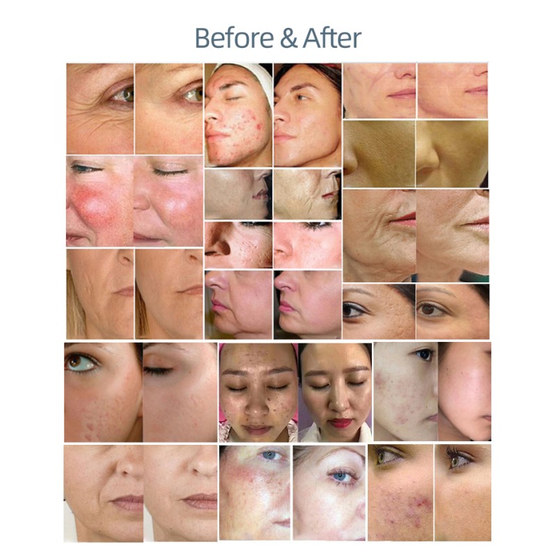 Light Therapy Device Factory - BOWKET Skin Rejuvenation Therapy PDT Devise Medical PDT Led