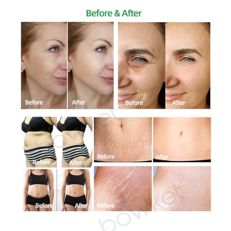 3D Body Shaper Factory - BOWKET Bio Vacuum Therapy Back Massager 80k Cavitation Machine Rf