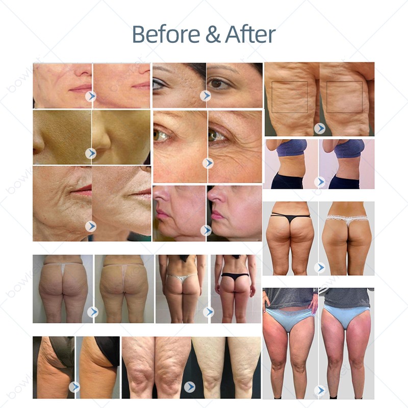 Ultrasonic Slimming Manufacturer - BOWKET 6 in 1 Cavitation Cellulite Reduce Face Sculpting Tool