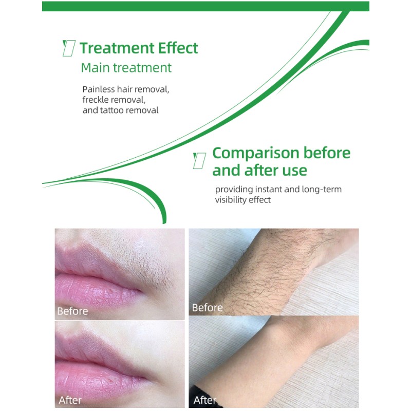 Medical Hair Removal Factory - Bowket Fast-Painless Permanent Diode Laser for Body Face Breast