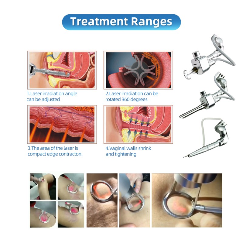 Portable CO2 Laser Manufacturer - BOWKET Fractional Scar Removal with Whitening Cooling OEM