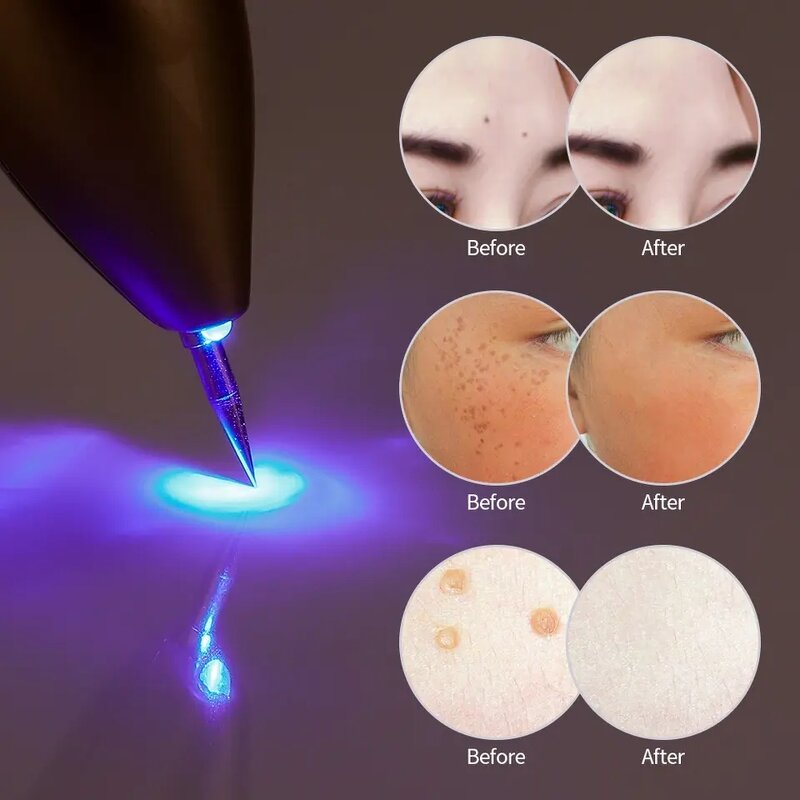 Plasma Pen Manufacturer - Wholesale Price for Facial Skin Care Body Laser Mole Spot Removal