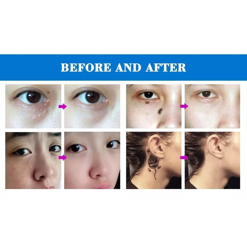 Beauty Pen Manufacturer - OEM Professional Hand-held Laser Plasma for Wart and Mole Removal US Plug