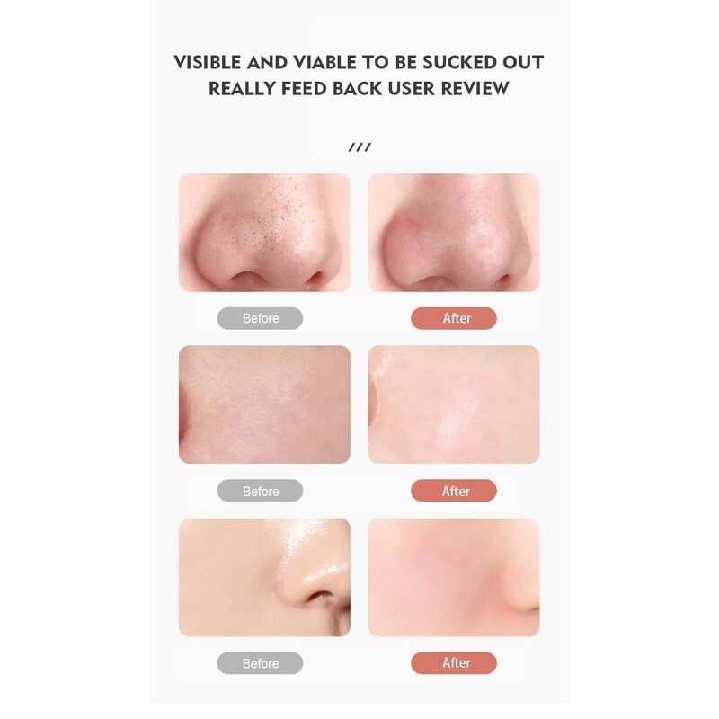 Blackhead Remover Manufacturer - LED Visible Camera Hot Cold Compress Vacuum for Acne Pore