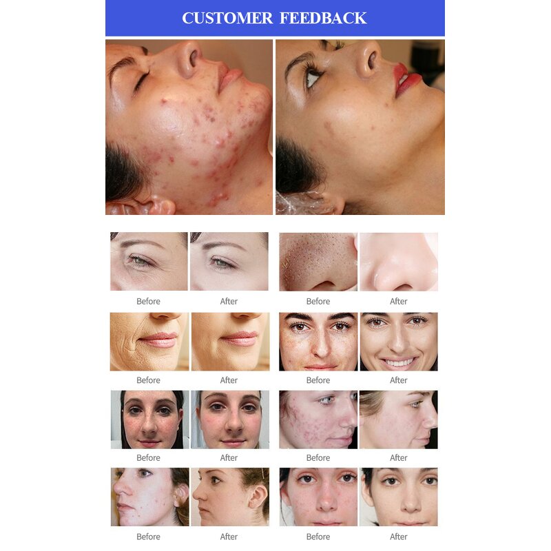 Beauty Equipment Manufacturer - 6 in 1 Desktop Aqua Dermabrasion Hydra Peeling Facial Bubble