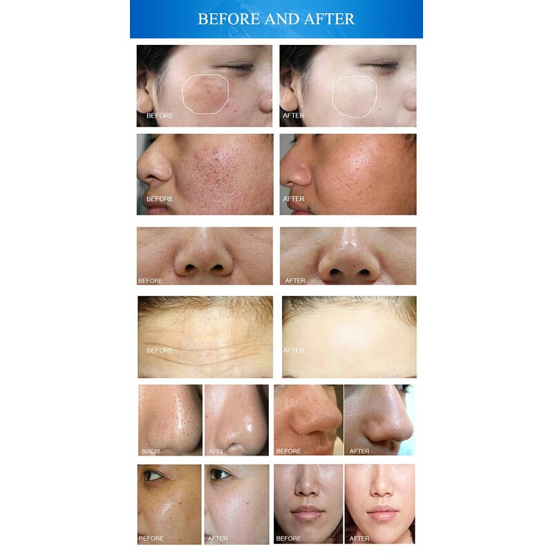 Microdermabrasion Machine Manufacturer - Small Bubble 9 Handle for Deep Skin Carving Peel