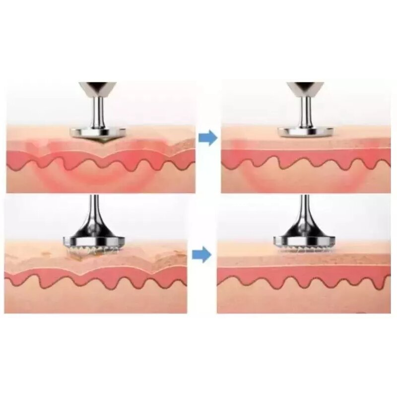 Beauty Pen Manufacturer - OEM Professional Hand-held Laser Plasma for Wart and Mole Removal US Plug