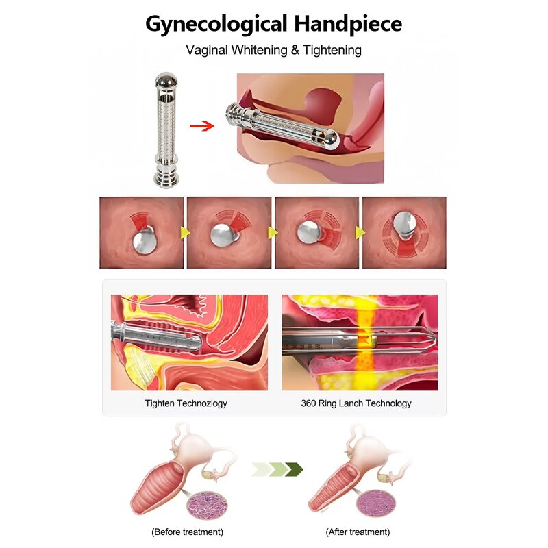 Fractional CO2 Laser - 10600nm Scar Removal Vaginal Tightening Machine