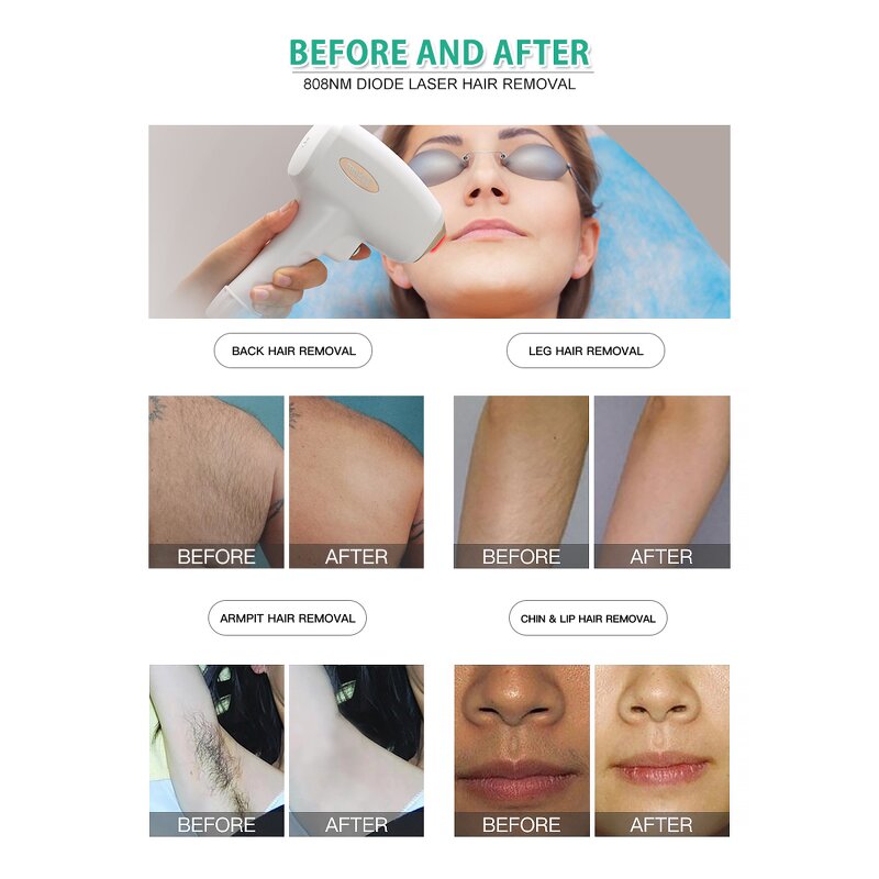 Diode Hair Removal Laser - High Power 755 808 1064 Triple Wave Salon Tool