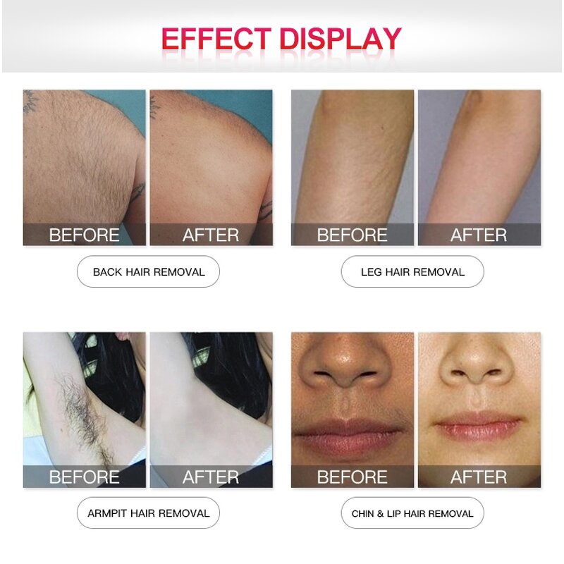 Diode Hair Removal Laser - High Power 755 808 1064 Triple Wave Salon Tool