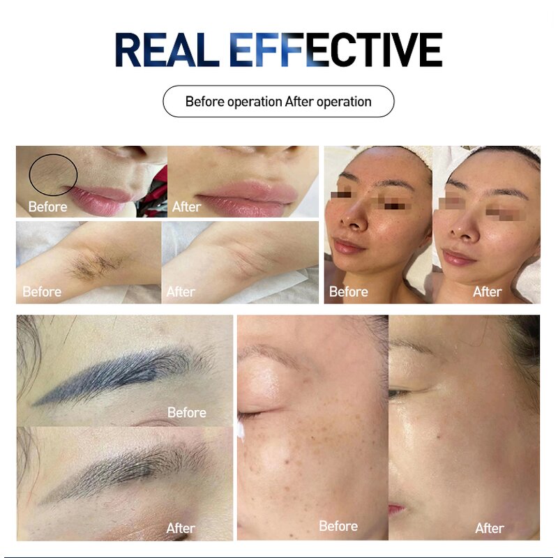 2-in-1 Laser Machine - Professional Hair Tattoo Removal Skin Rejuvenation SPA