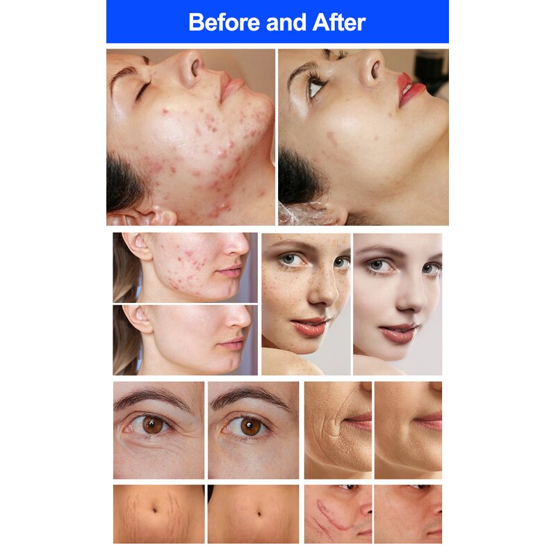 Portable CO2 Laser - 10600nm Skin Resurfacing Face Lifting Rejuvenation