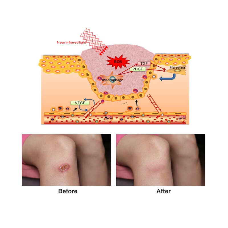 Red Light Therapy Device Manufacturer - for Acute Joint Pain Relief 650nm 808nm