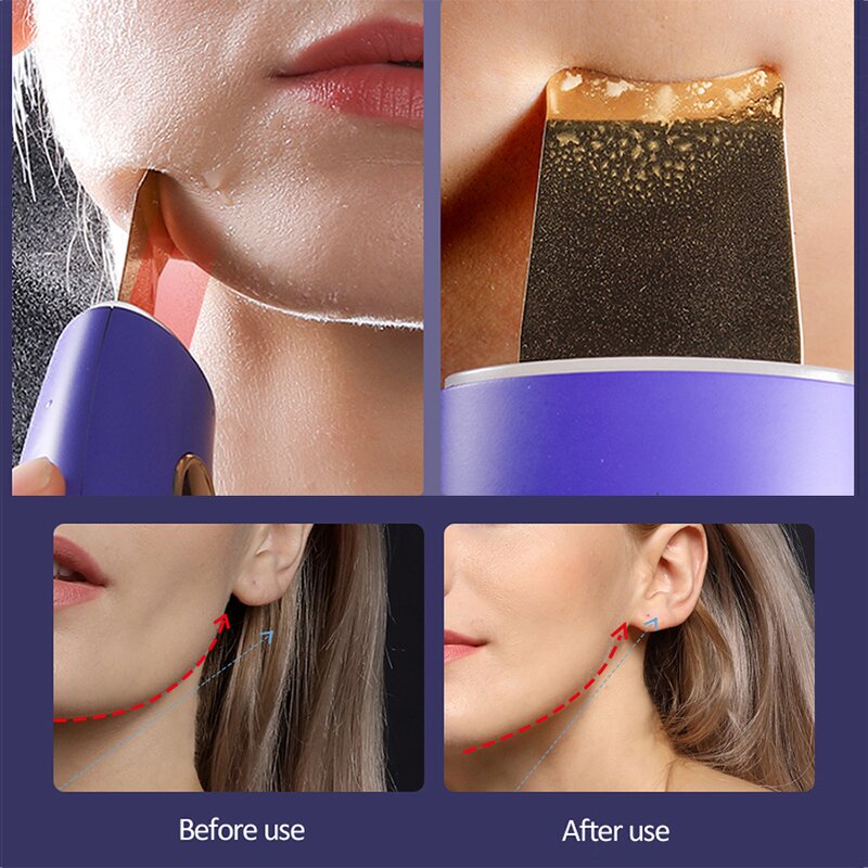 Ultrasonic Pore Cleanser - Spatula Acne Exfoliator Blackhead Remover Tool