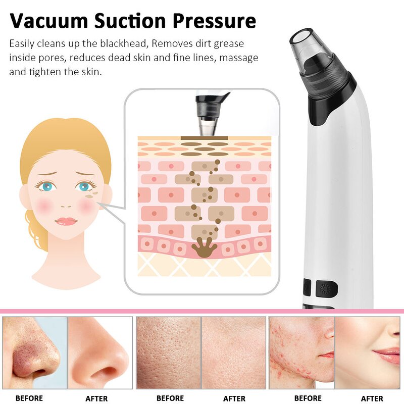 Small Bubble Blackhead Remover - Facial Pore Cleaner Acne Removal Device