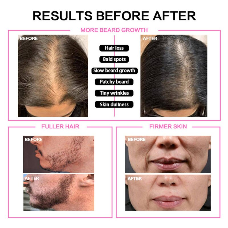 High Frequency Skincare Device - Handheld Facial Wand Treatment EU Plug