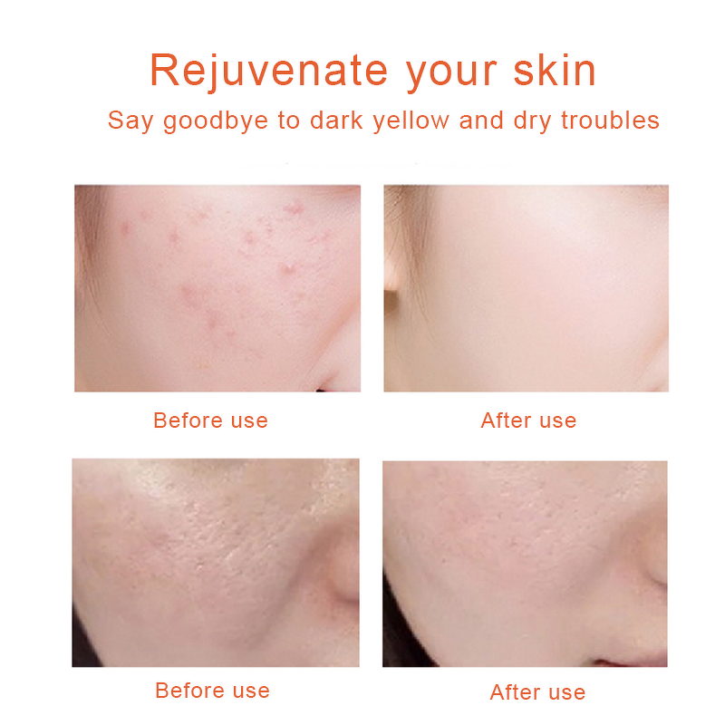 Nano Oxygen Injection Instrument - Portable Home Facial Rejuvenation Tool