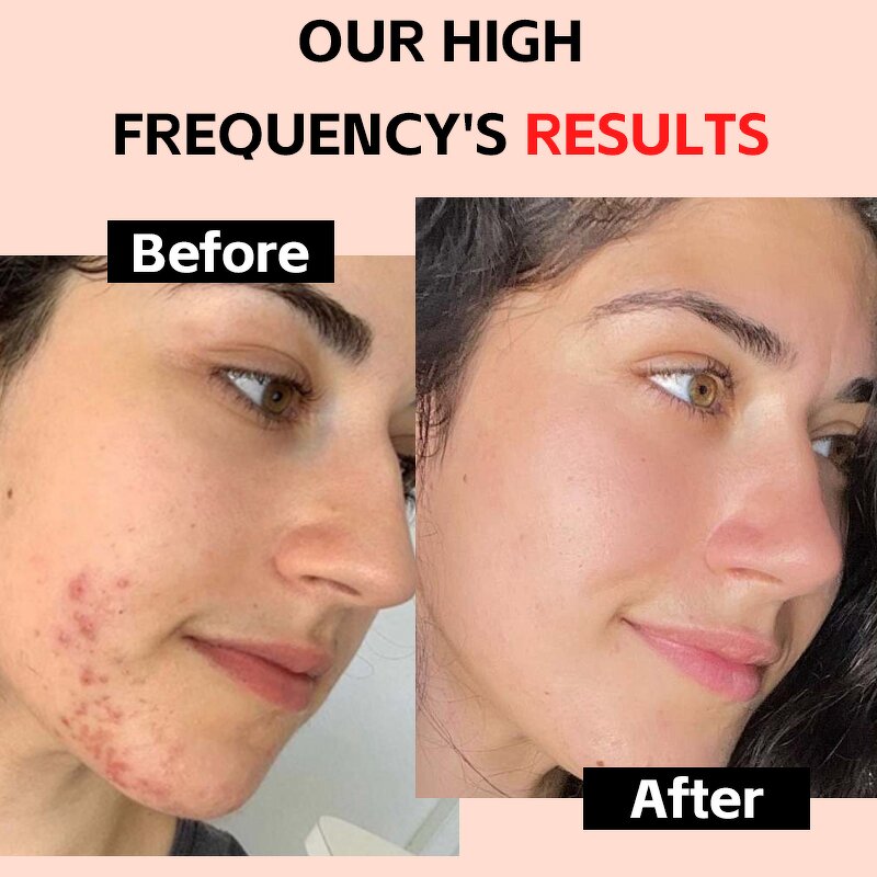 High Frequency Skin Therapy Wand Manufacturer - Custom Portable Handheld New Microcurrent Facial