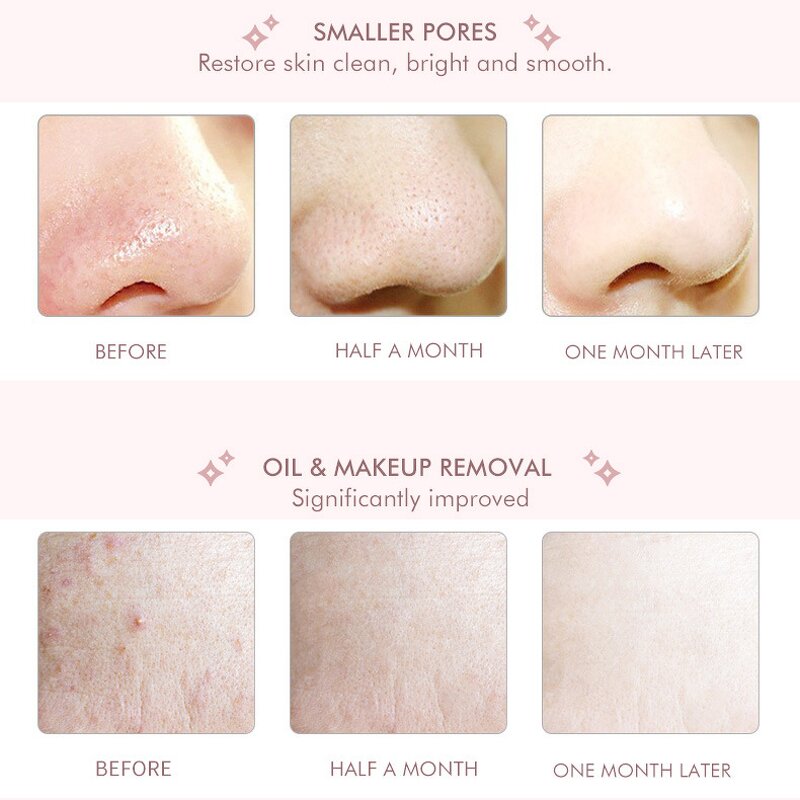 Skin Spatula Manufacturer - 2023 Sonic Ultrasonic Blackhead Peeling