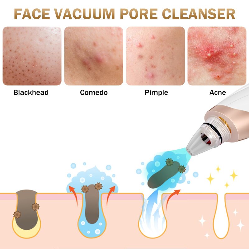 Facial Pore Cleaner Manufacturer - Electric Comedone Whitehead Extractor Rechargeable for Women